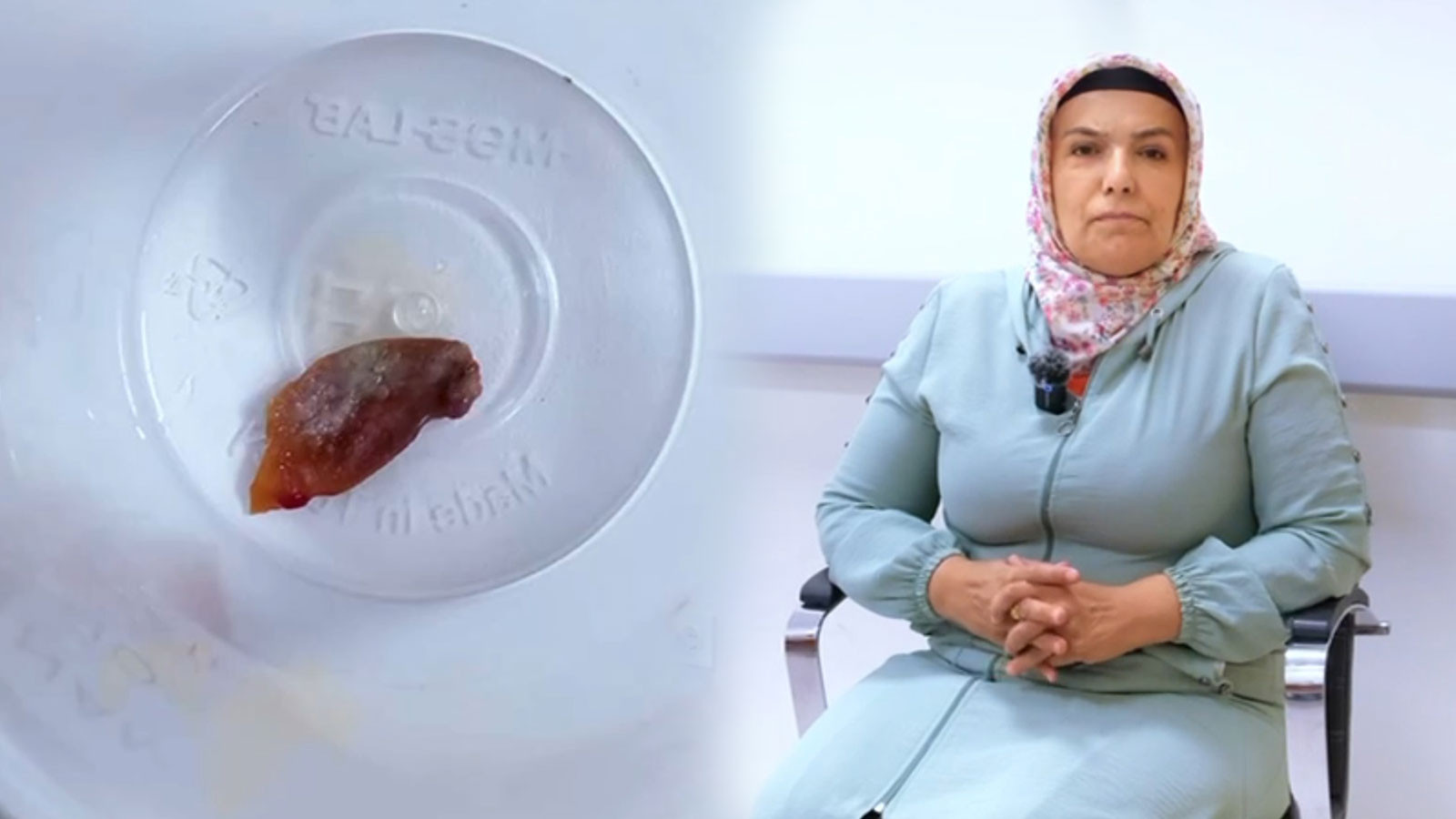 1 buçuk senedir geçmeyen öksürüğünün nedenini öğrenince hayatının şokunu yaşadı: Akciğerine yapışmış!