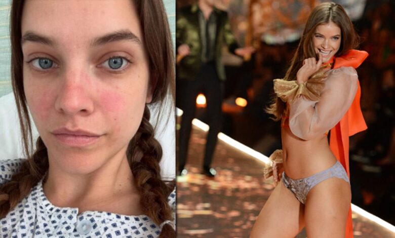 Barbara Palvin, endometriozis nedeniyle ameliyat oldu
